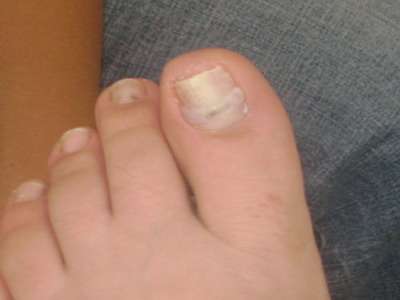 Вросший ноготь. Пластины Подофикс